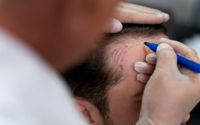 Quels sont les résultats d’une greffe de cheveux avant après avec le docteur Cinik ?